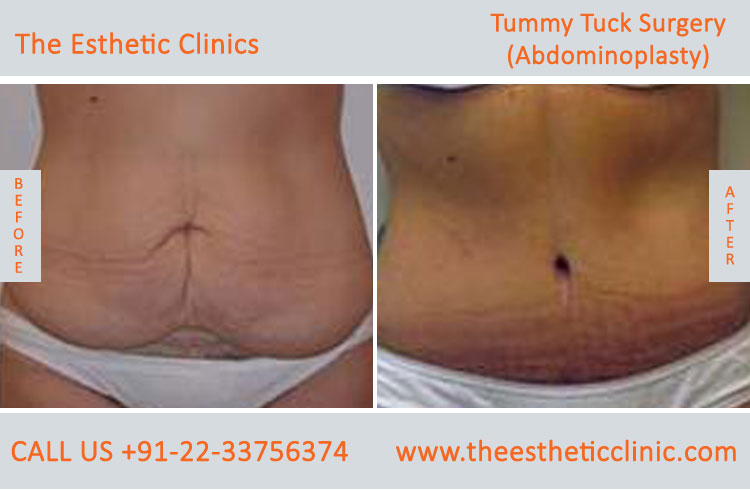 Tummy Tuck Surgery, Abdominoplasty before after photos in mumbai india (5)